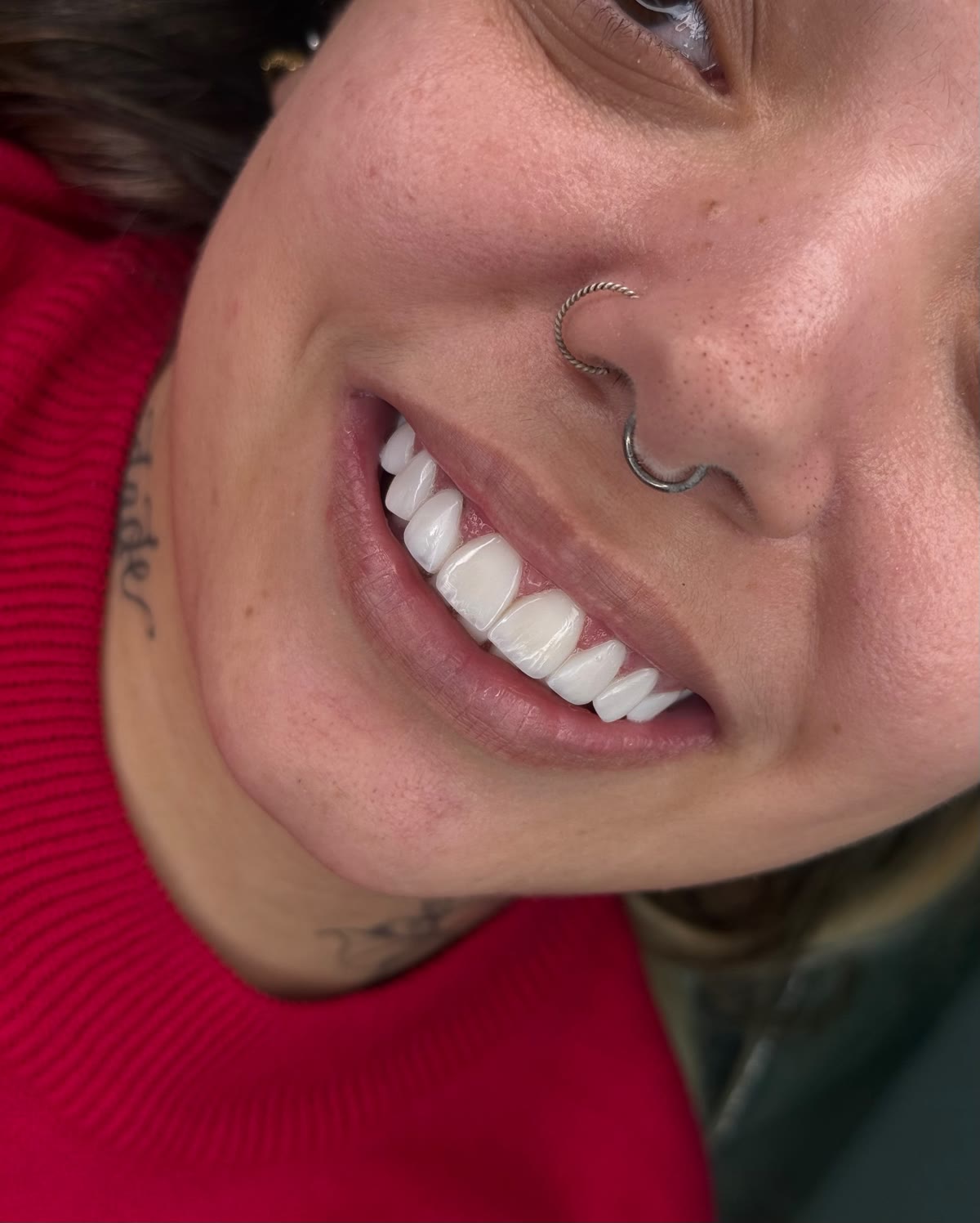 Sorriso de paciente com lentes em resina estratificada