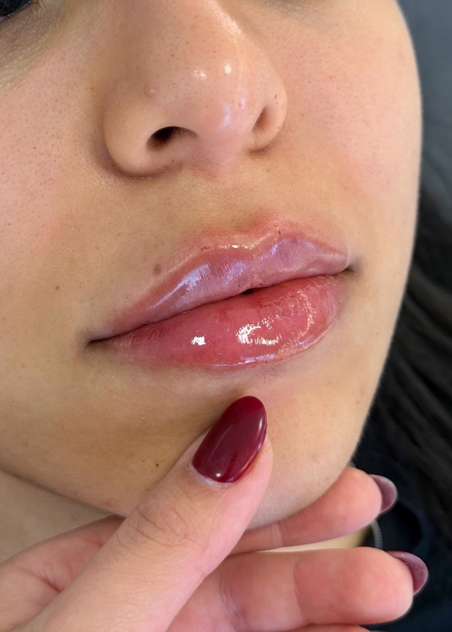 Paciente da clínica após preenchimento labial