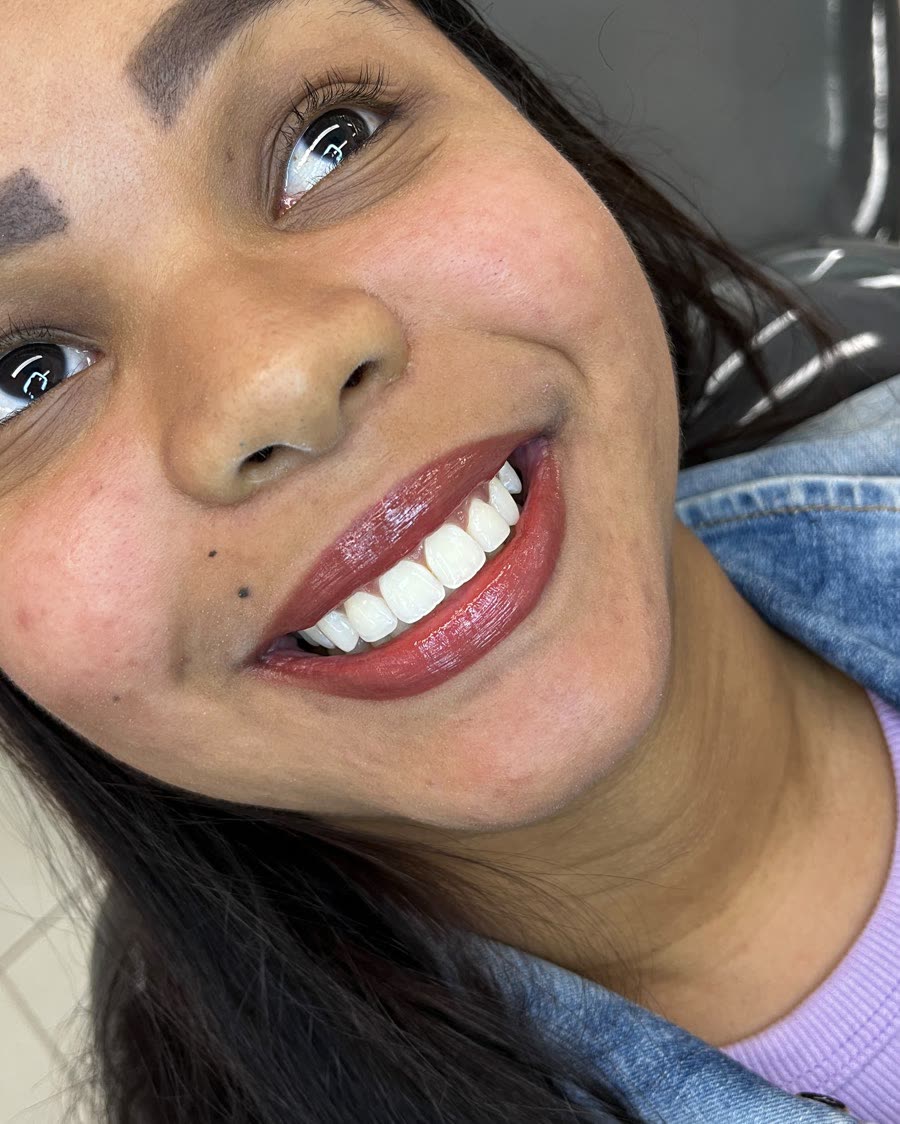 Depois do tratamento de clareamento dental