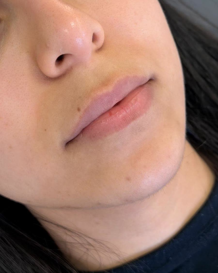Antes do tratamento de preenchimento labial