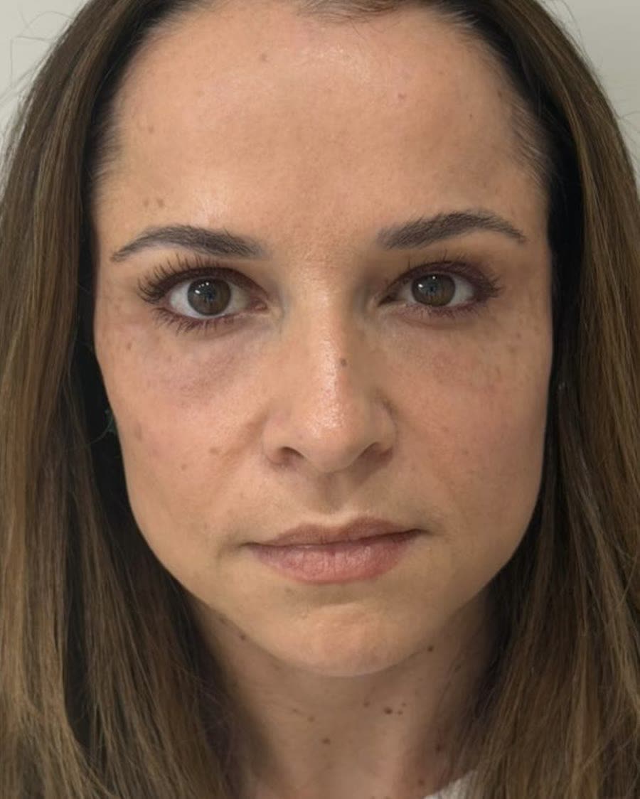 Depois do tratamento de reestruturação facial